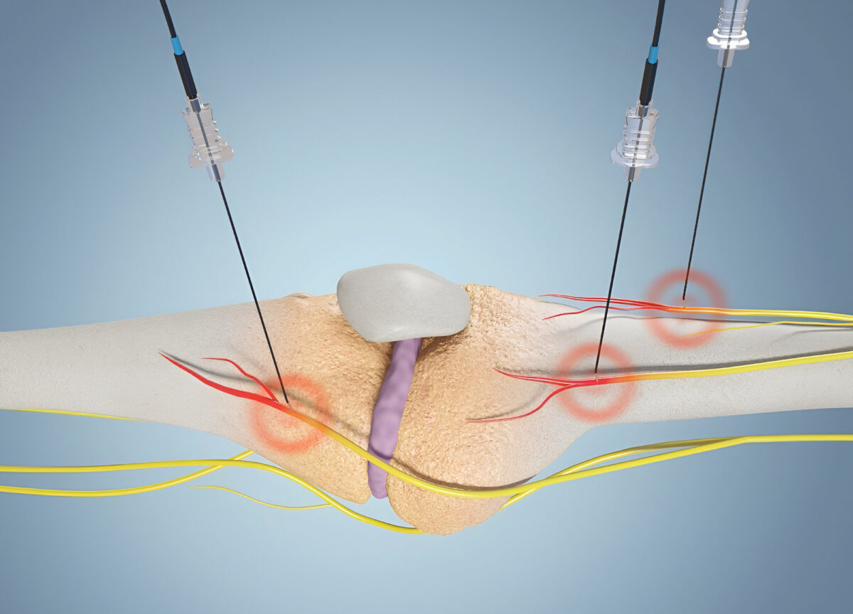 Duální radiofrekvenční léčba kolenního kloubu