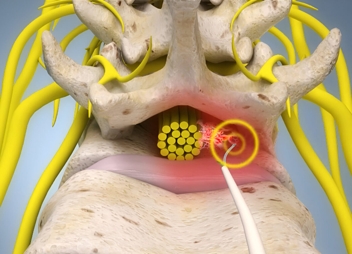 Epiduroskopicky asistovaná adheziolýza v epidurálním prostoru (epiduroskopie)