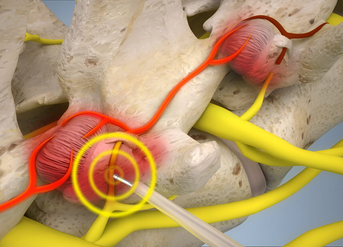Perkutánní endoskopická denervace meziobratlových kloubů